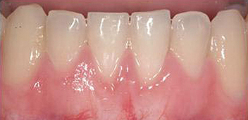 Periodontics-after