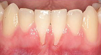 Periodontics-before