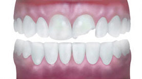 veneers-chipped-tooth