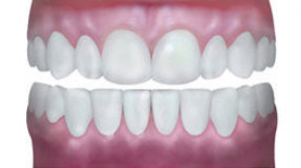 veneers-natural-appearance